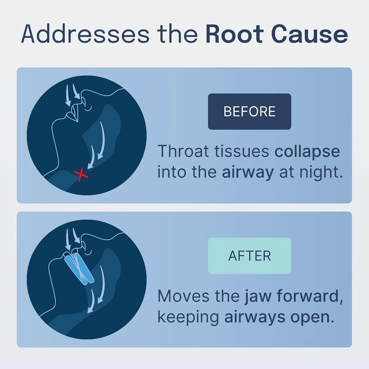 Before-and-after diagram: throat tissues collapse into the airway at night; the guard moves the jaw forward, keeping airways open